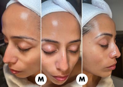 Hydrafacial at Mongael Aesthetics Chicago Before and After.