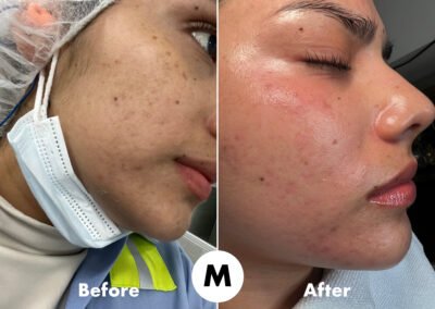 Hydrafacial and Acne Treatment at Mongael Aesthetics Chicago Before and After.